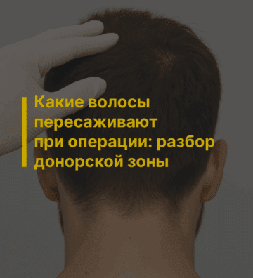 Какие волосы пересаживают при операции: разбор донорской зоны