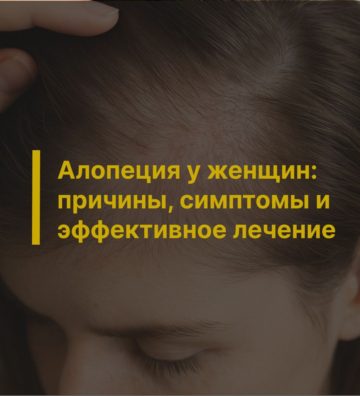 Алопеция у женщин: причины, симптомы и эффективное лечение