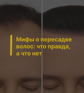 Мифы о пересадке волос: что правда, а что нет