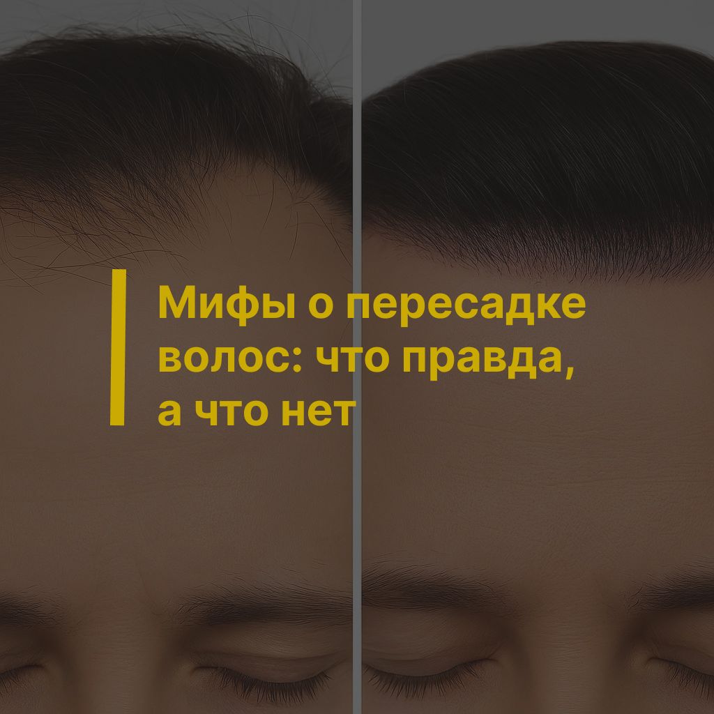 Мифы о пересадке волос: что правда, а что нет
