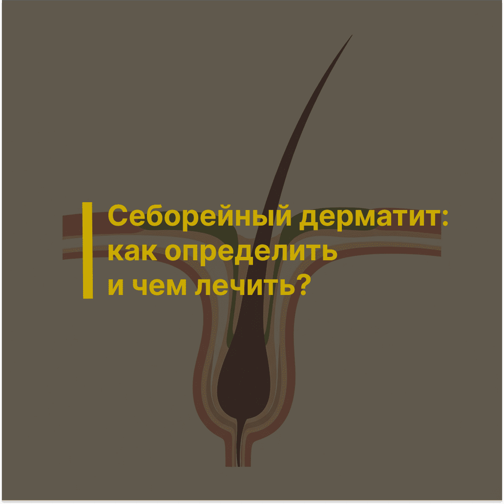 Себорейный дерматит: как определить и чем лечить?